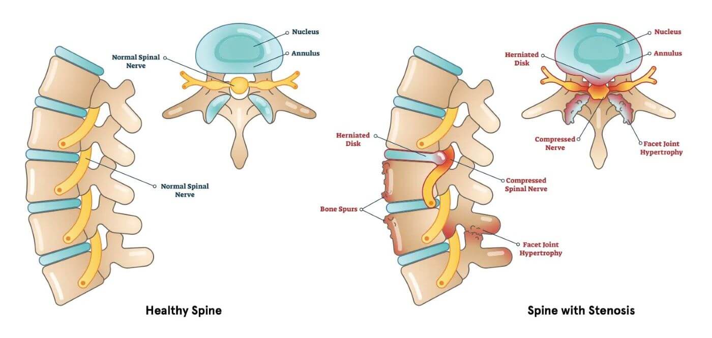Healthy Spine Compared to Spine with Stenosis