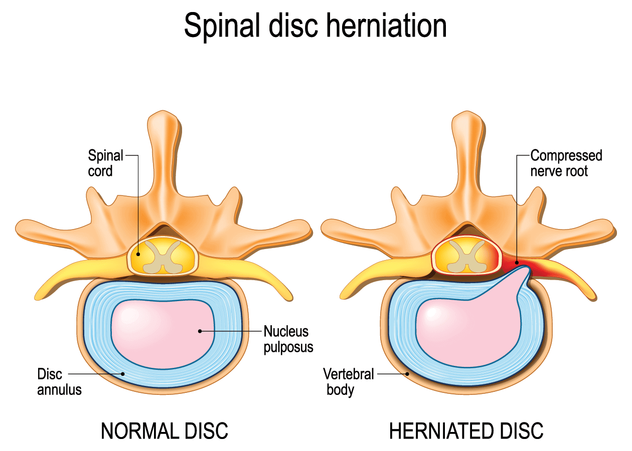 Normal Disc vs. Herniated Disc