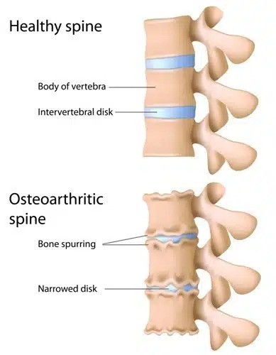 Healthy vs. Osteoarthritic Spine