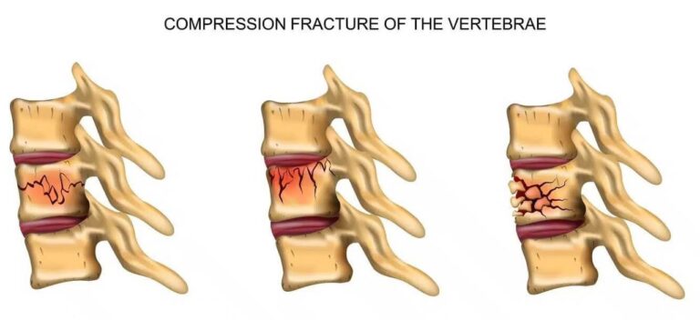 Compression Fracture of the Vertebrae