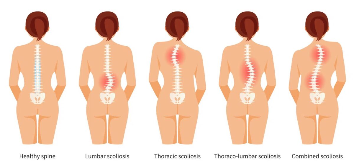 Scoliosis Diagram