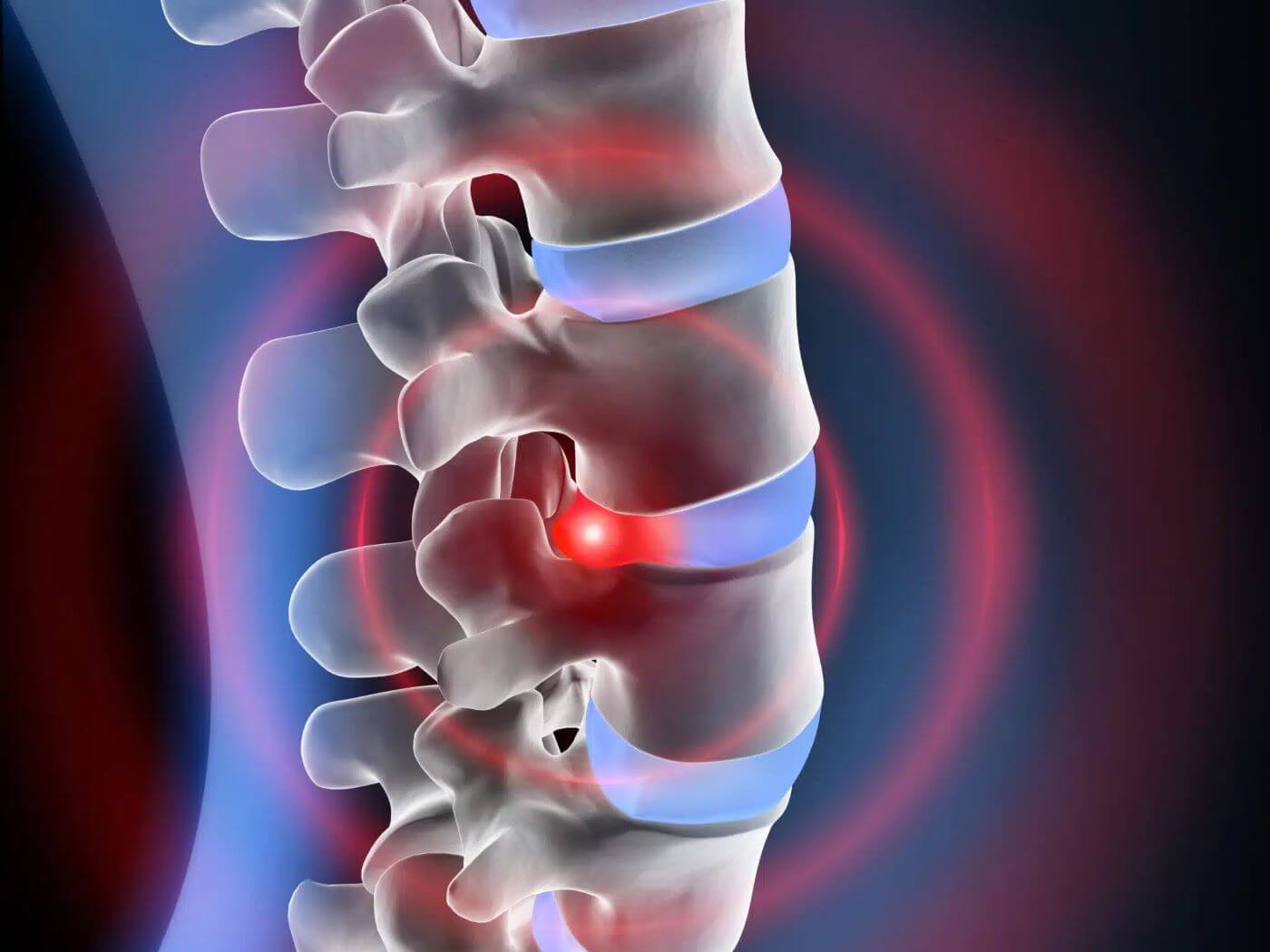 Degenerative Disc Disease
