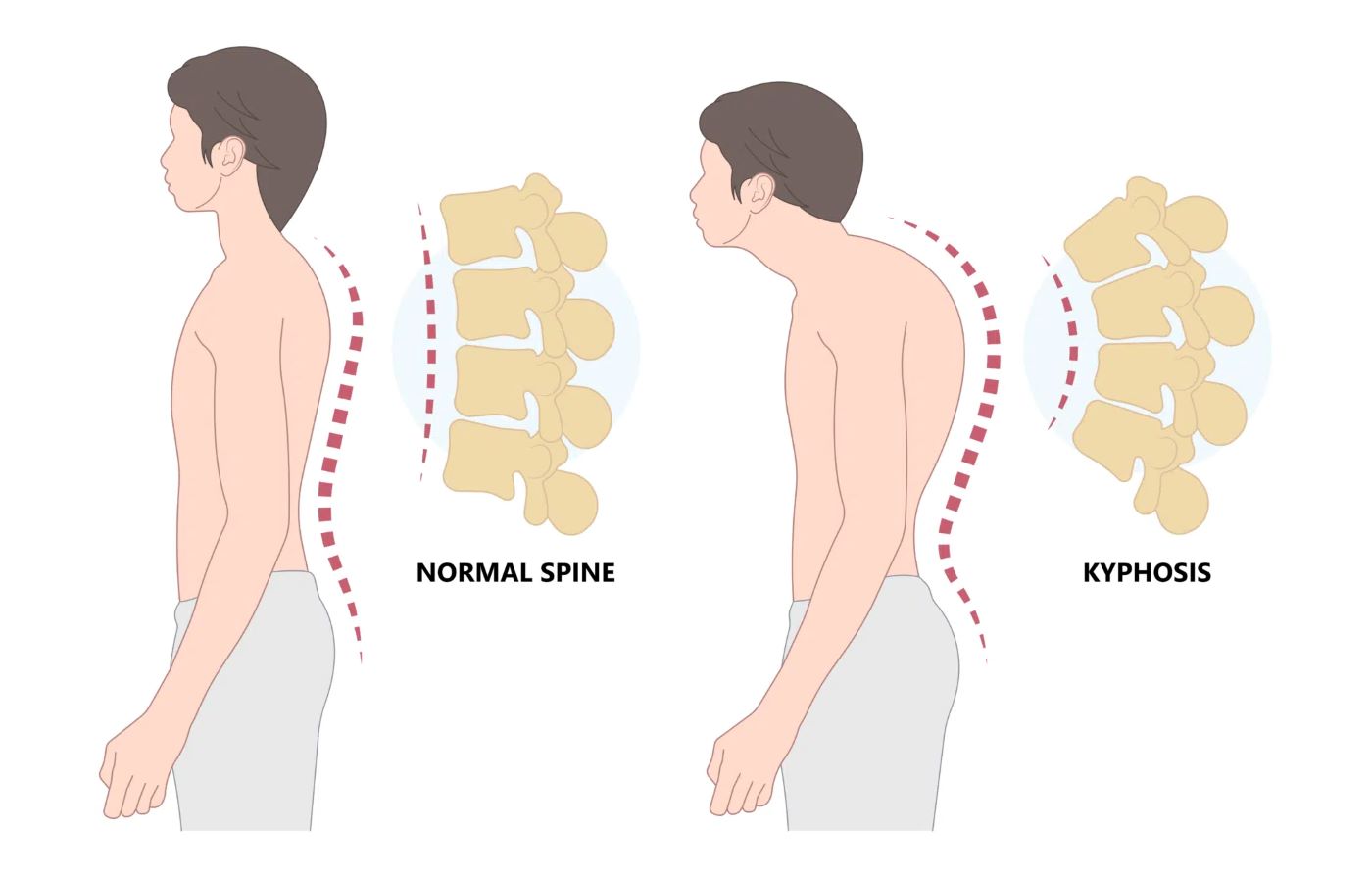 Kyphosis Diagram
