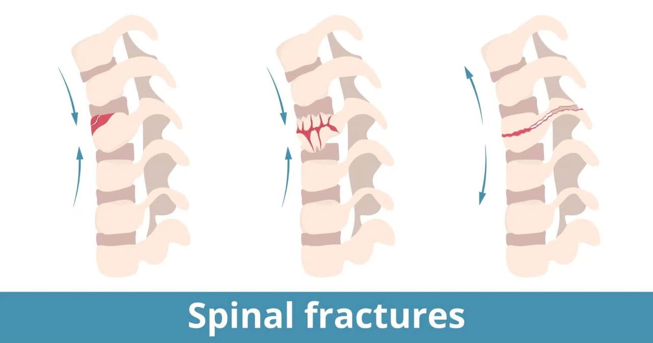 Spinal Fractures