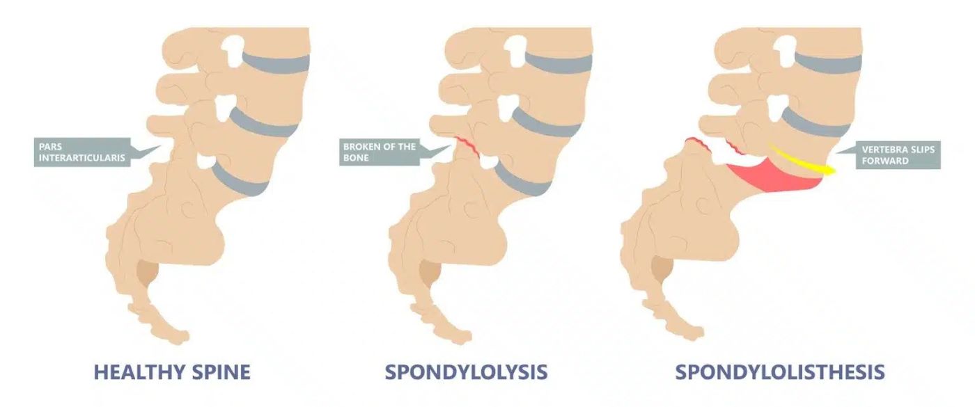 Healthy Spine as Compared to Spondylosis and Spondylolisthesis