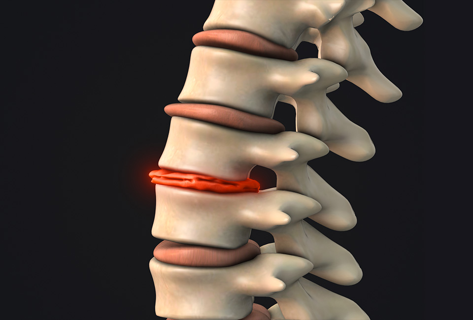 3D degenerative disc