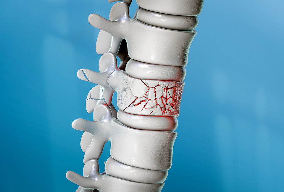 3D spinal fracture