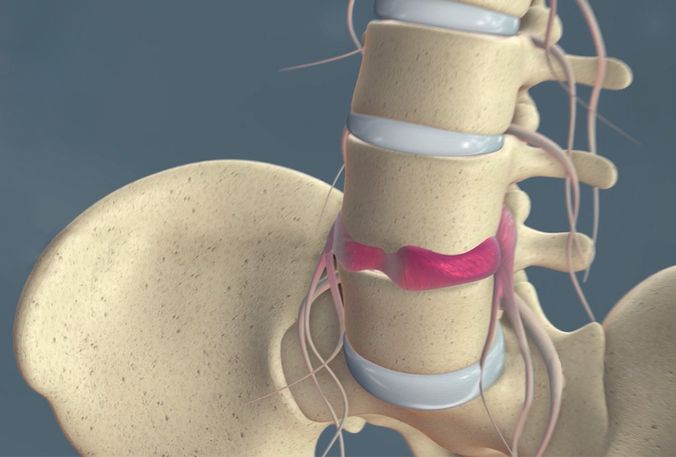 Lumbar slipped disc