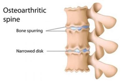 Osteoarthritis of the Spine